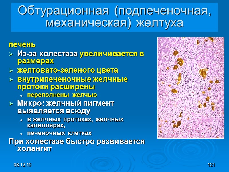 08:12:02 121 Обтурационная (подпеченочная, механическая) желтуха печень  Из-за холестаза увеличивается в размерах 